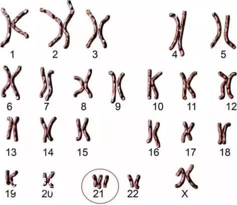 21號染色體多1條