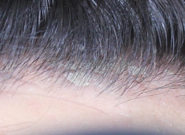 濫用地塞米松可能會引起毛囊炎等危害