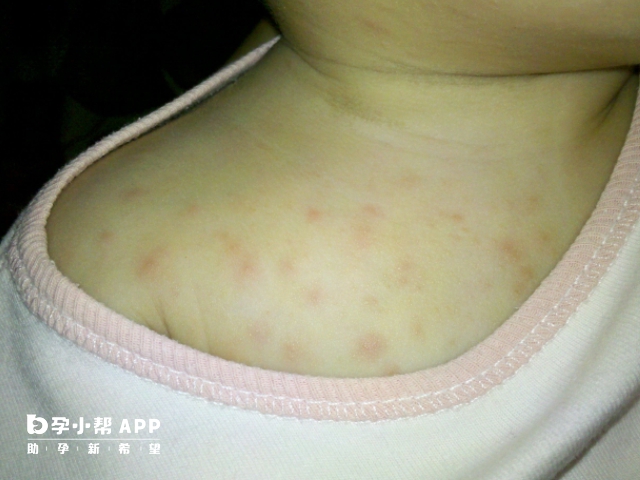 湿疹作为一种常见的皮肤病