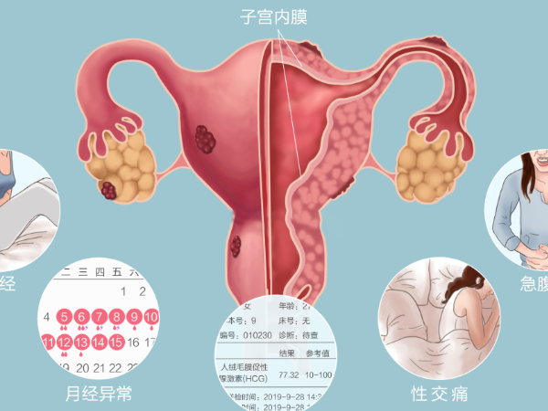 內膜異位症會表現為痛經