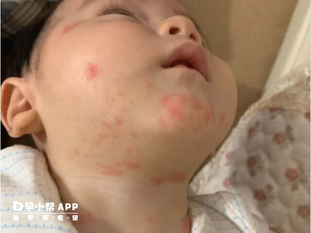 新生儿出现湿疹需要保持皮肤干净