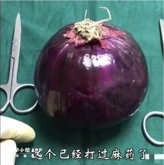 洋蔥模仿剖腹產手術