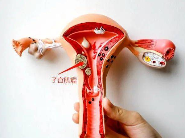 預防子宮肌瘤就要避免人流