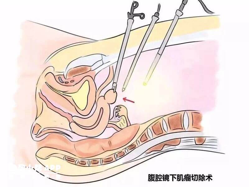 试管前先治疗子宫肌瘤