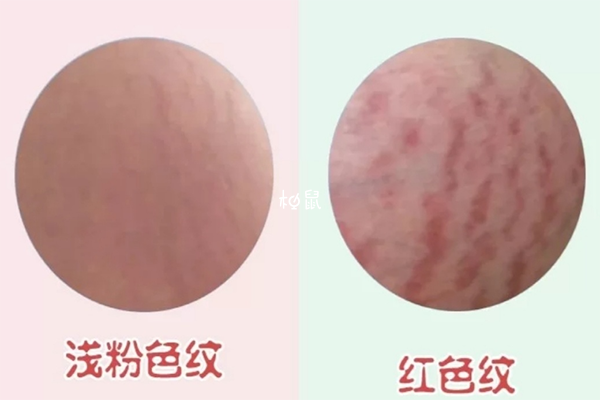 從裂紋的顏色判斷妊娠紋