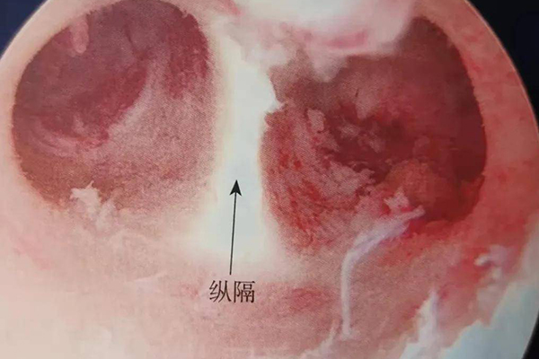 发现宫腔粘连要积极治疗