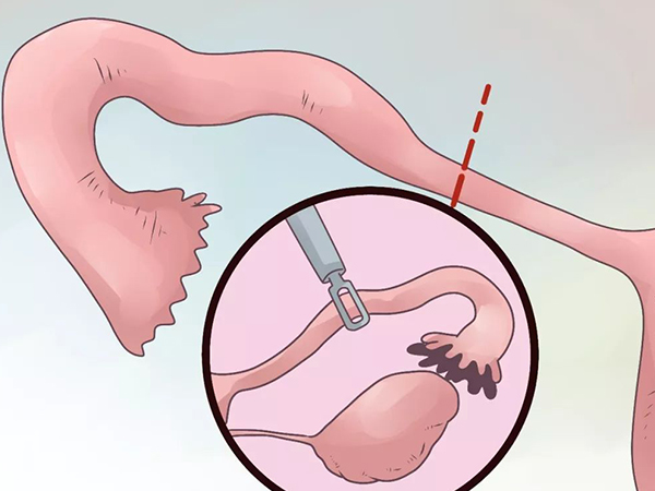 輸卵管切除對女性生育有影響