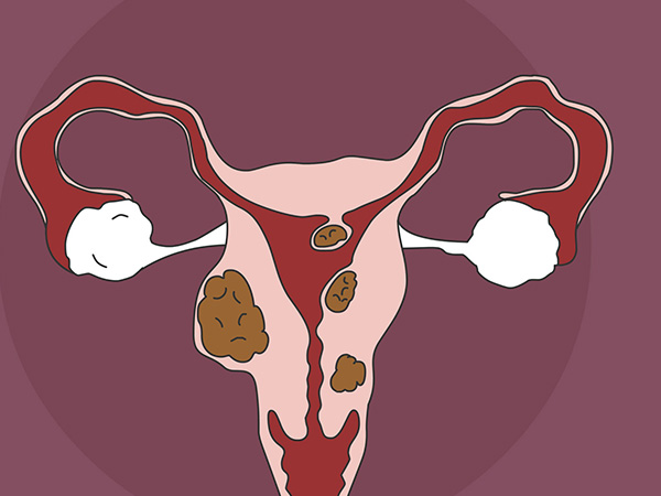 子宫肌瘤会引起月经异常