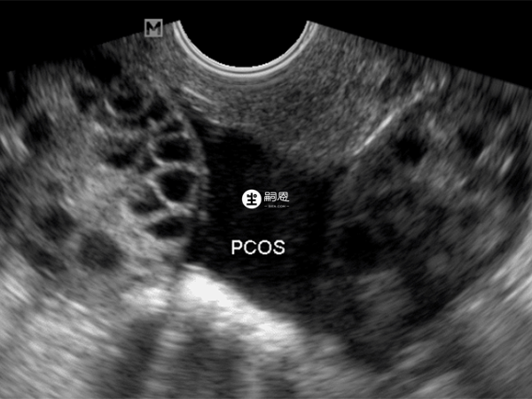 多囊卵巢綜合徵是一種生殖內分泌代謝性疾病