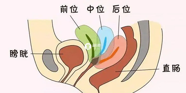 子宮前位和子宮後位的位置區別