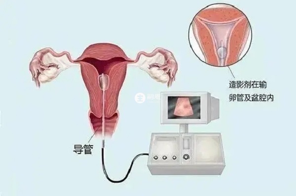 輸卵管造影可檢查輸卵管是否粘連