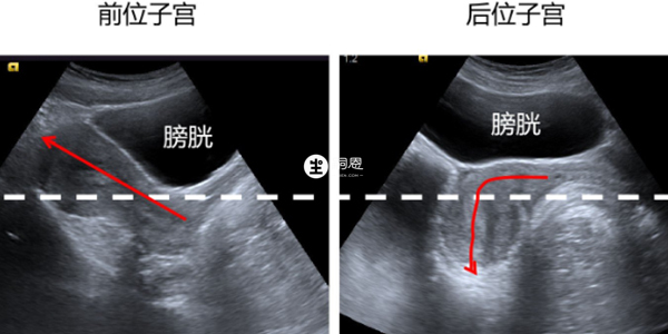 經腹部檢查子宮前位和後位