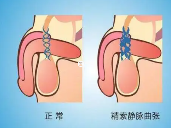 精索静脉曲张患者可以做试管婴儿