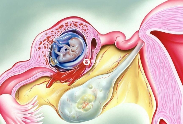 宫外孕一般是在怀孕40天到50天做b超检查出来