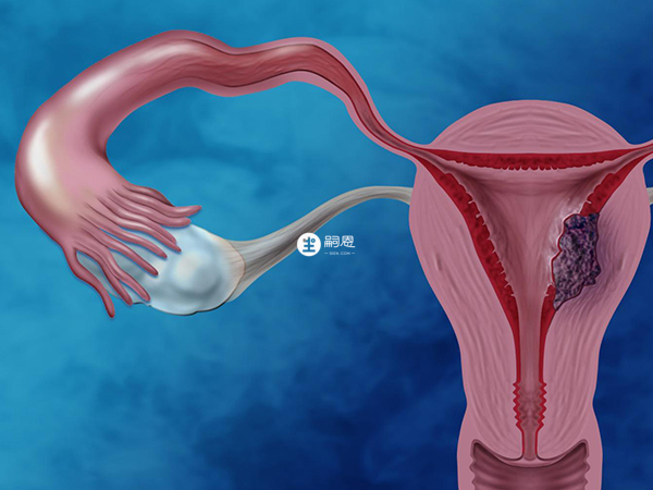 始基子宫是一种生殖畸形