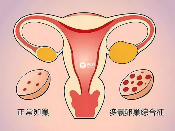 多囊卵巢综合征简称PCOS