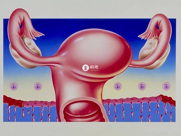 子宫肌瘤是妇产科常见的良性肿瘤