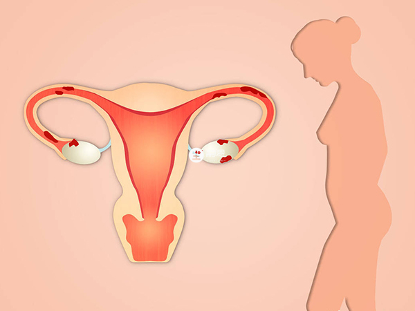 輸卵管堵塞會影響精子和卵子的結合