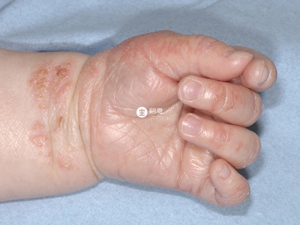 婴儿手部湿疹变现为发红干燥