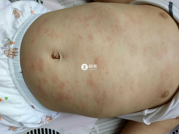 特应性皮炎是常见的湿疹