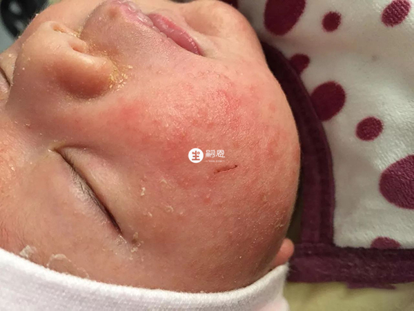 婴儿湿疹容易擦烂红肿