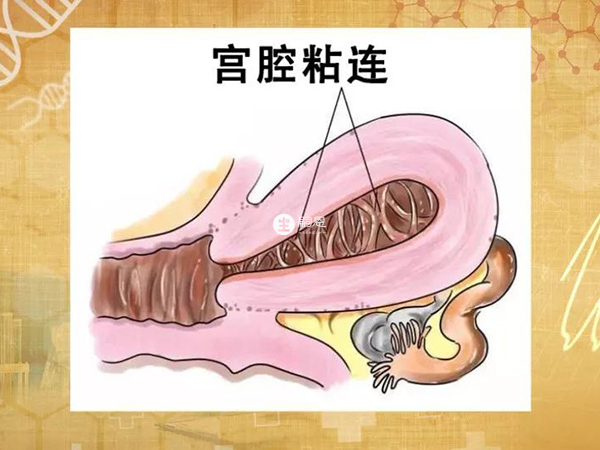 宫腔粘连指子宫腔内的广泛粘连情况