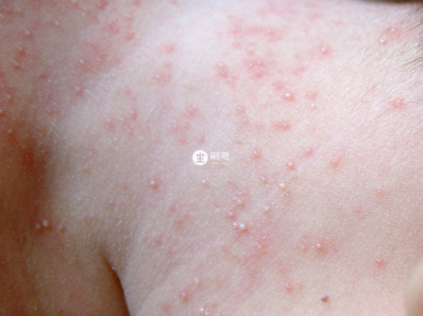 红色丘疹密集成片就是热疹