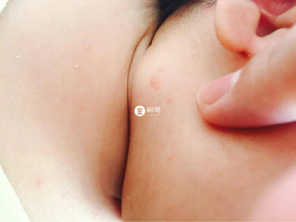 婴儿湿疹是一种过敏性皮肤现象