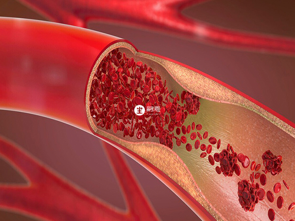 速碧林可预防静脉血栓栓塞性疾病