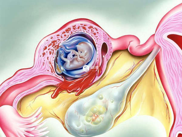 宮外孕或和生化妊娠有區別