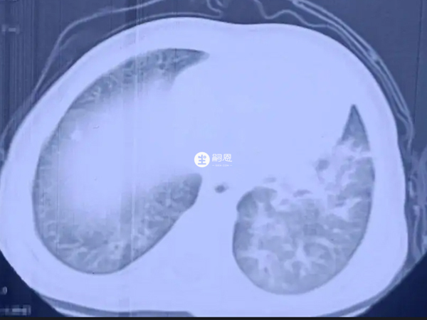 新生兒吸入羊水可導致肺部感染