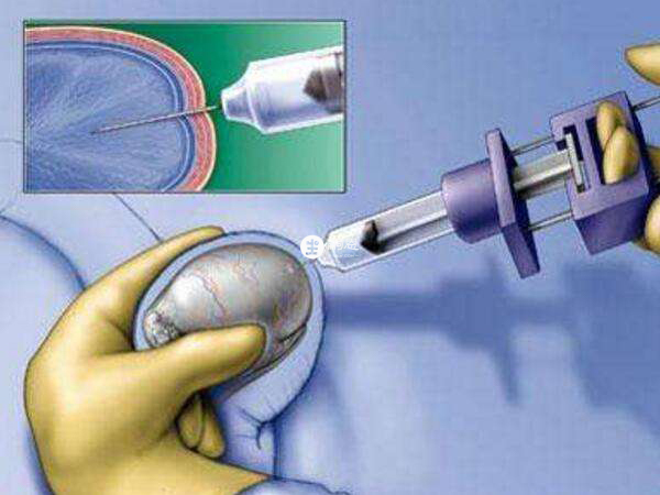 睾丸穿刺无精子可能是生精功能障碍