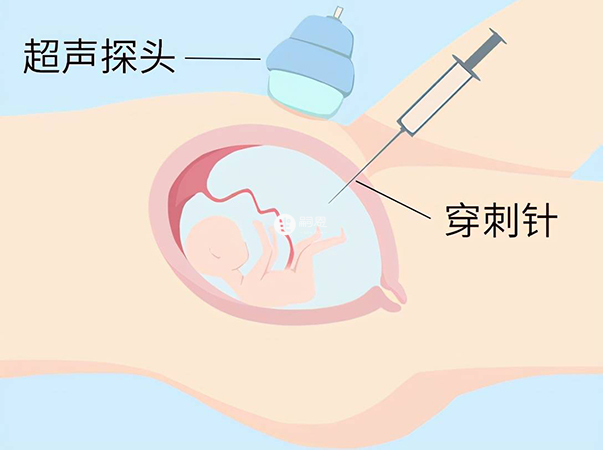 很多孕媽自述後悔做唐氏篩查羊水穿刺