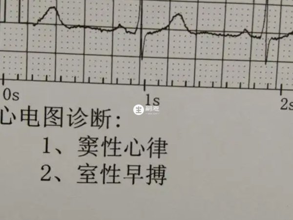 房室早博是早搏之一