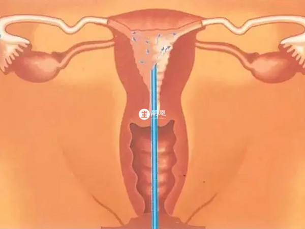 人工授精是将精子直接注入女性宫腔