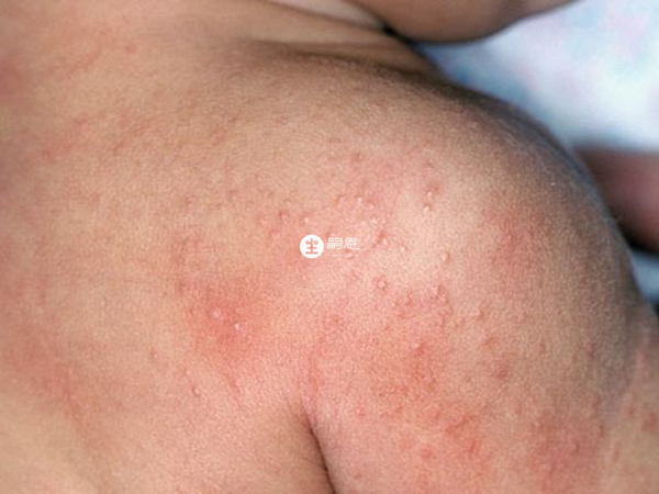 脂溢性皮炎服用甘草鋅膠囊有好處