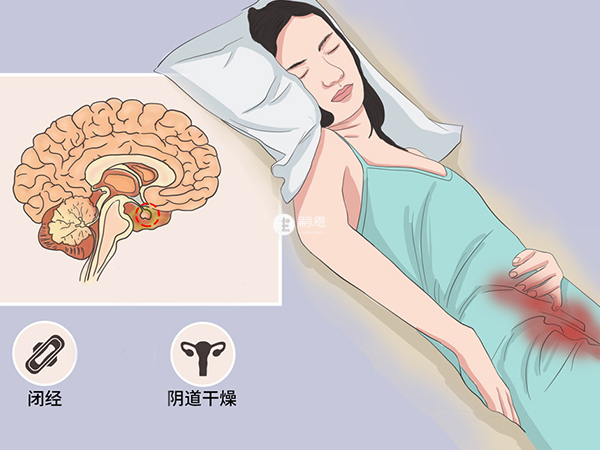 乙烯雌酚對女性外陰乾枯症有作用