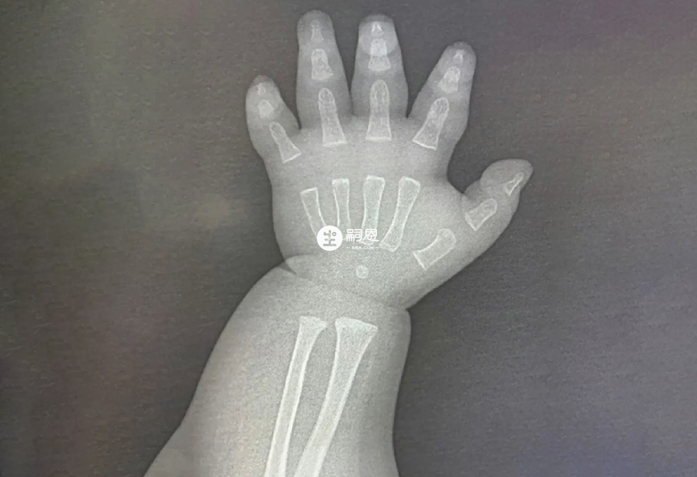 X光下的婴儿小手骨骼图