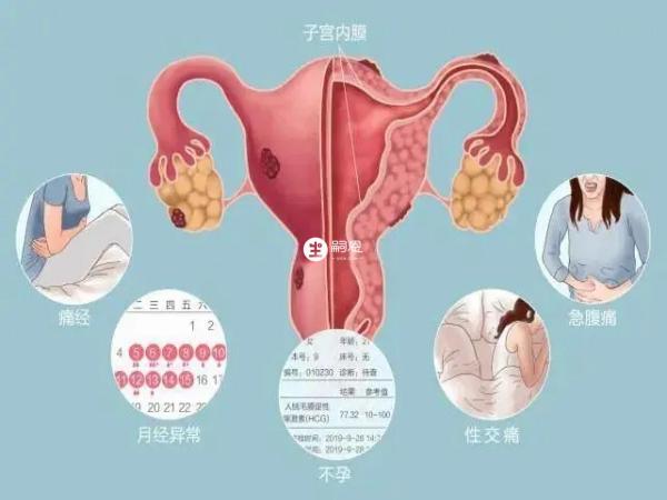 子宫内膜异位症试管成功案例分享