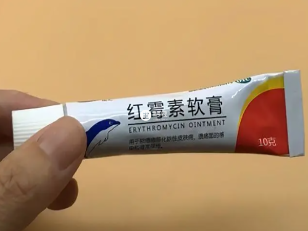 水痘可以採用紅黴素軟膏治療