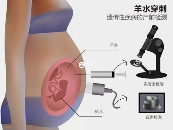 羊水穿刺不能檢查出胎兒智力