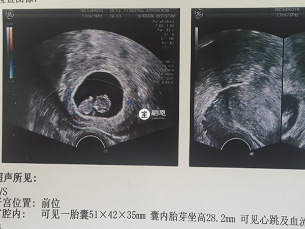 胎囊看男女不一定可靠