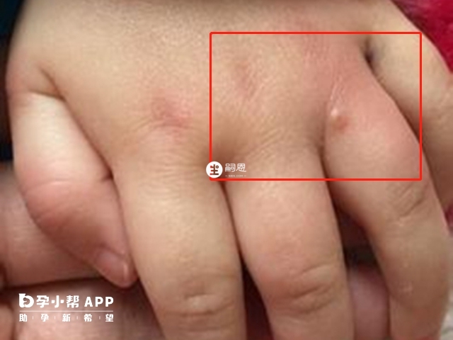 手足口病毒感染初期会疱疹