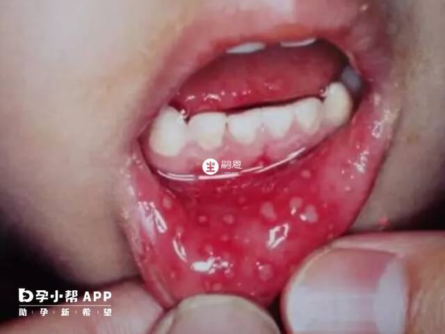 感染上手足口病早期会有口腔粘膜疹