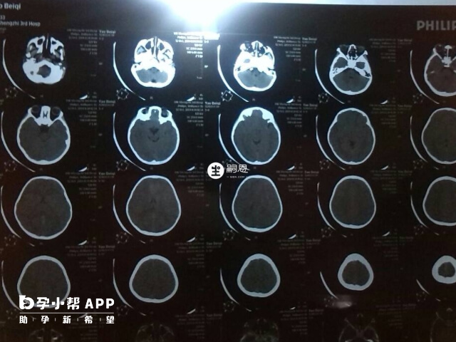 不建議兒童做腦部CT的原因
