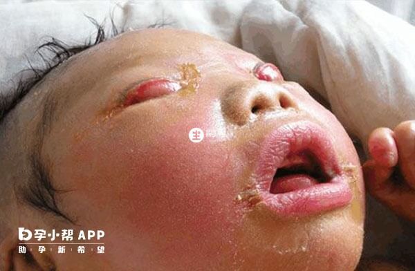 火棉膠嬰兒治療方案