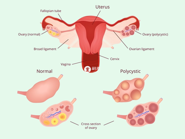多囊卵巢会导致不孕不育