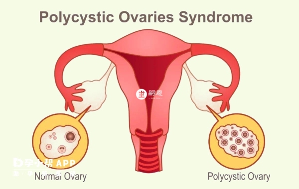 多囊卵巢可用多吃药物治疗