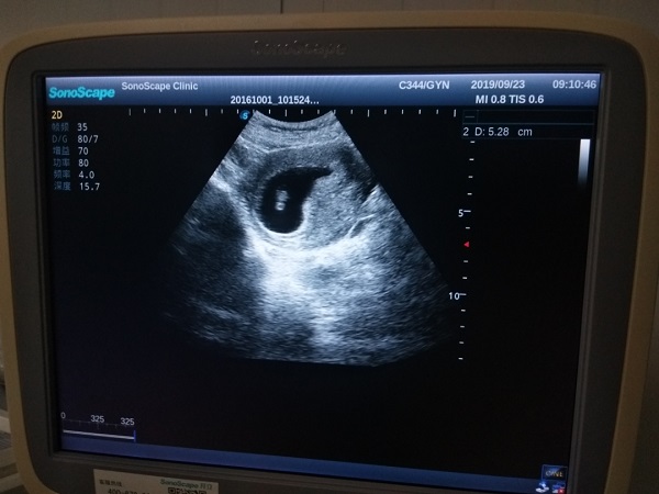 移植21天能看到孕囊
