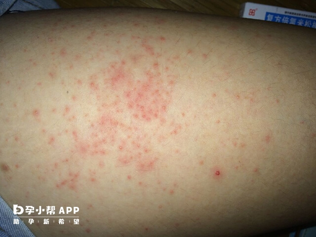 婴儿湿疹对皮肤的伤害